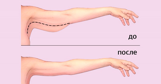 Как избавиться от лишнего жира на руках: 3 способа, которые работают. Возьмите себе на заметку.