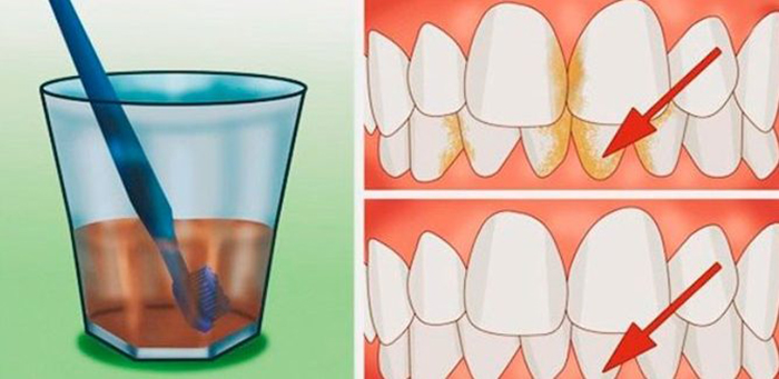 Лучшее средство для удаления зубного камня, воспаления десен и отбеливания зубов